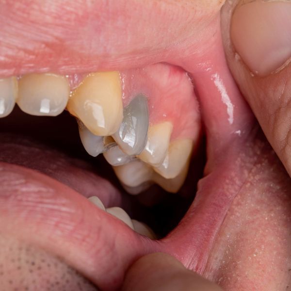 manchas dientes